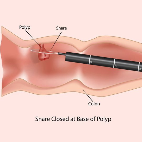 Polypectomy